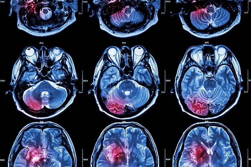 Saiba porque implantar o anel de ferrara ceratocone