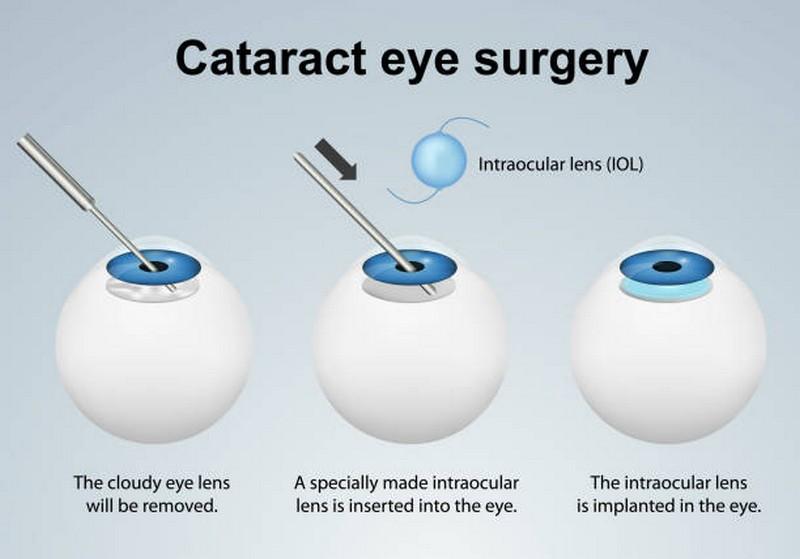 Entenda onde pode ser feita a cirurgia de catarata preço