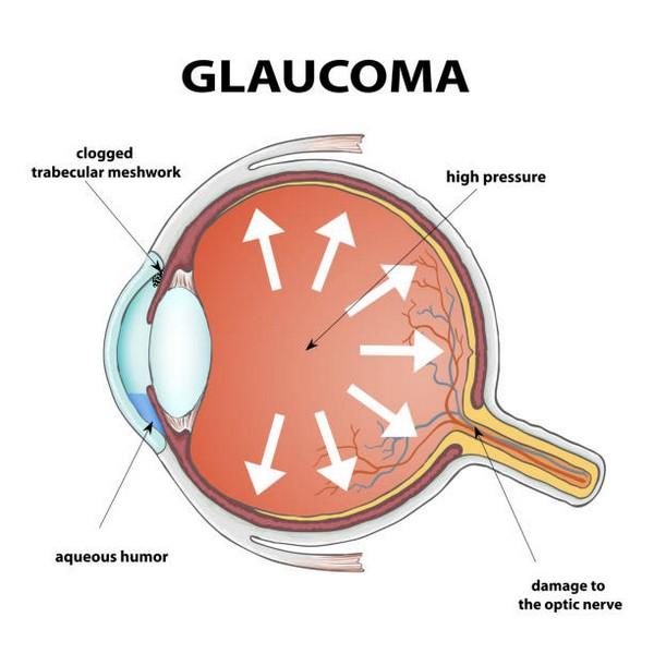 Conheça a cirurgia glaucoma