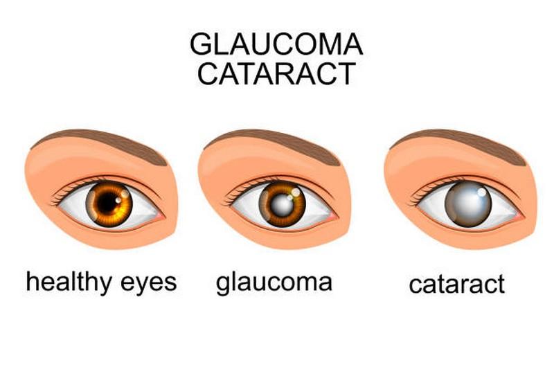 Como saber se tenho glaucoma? Conheça a doença e como tratá-la
