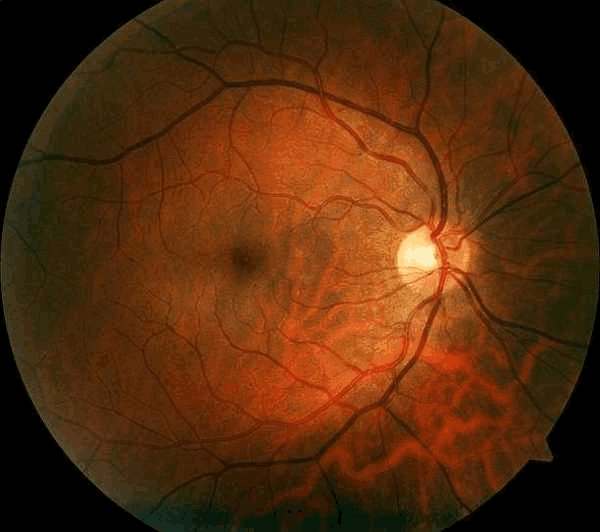 Cirurgia ocular retinopatia