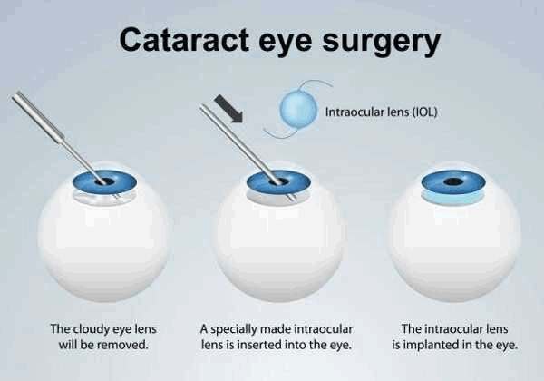 Implante de lente intraocular monofocal