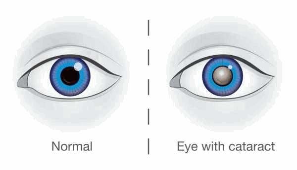 Lente intraocular multifocal tórica