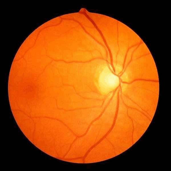 Mapeamento de retina binocular preço